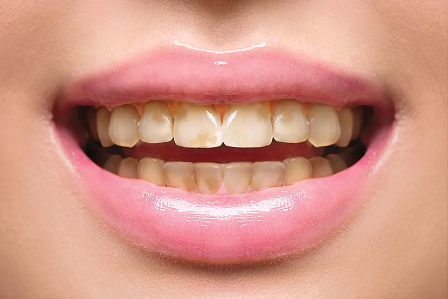 esthetisme des dents dentiste